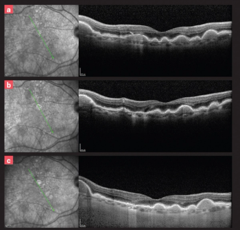 What’s hot (and not) in retinal news