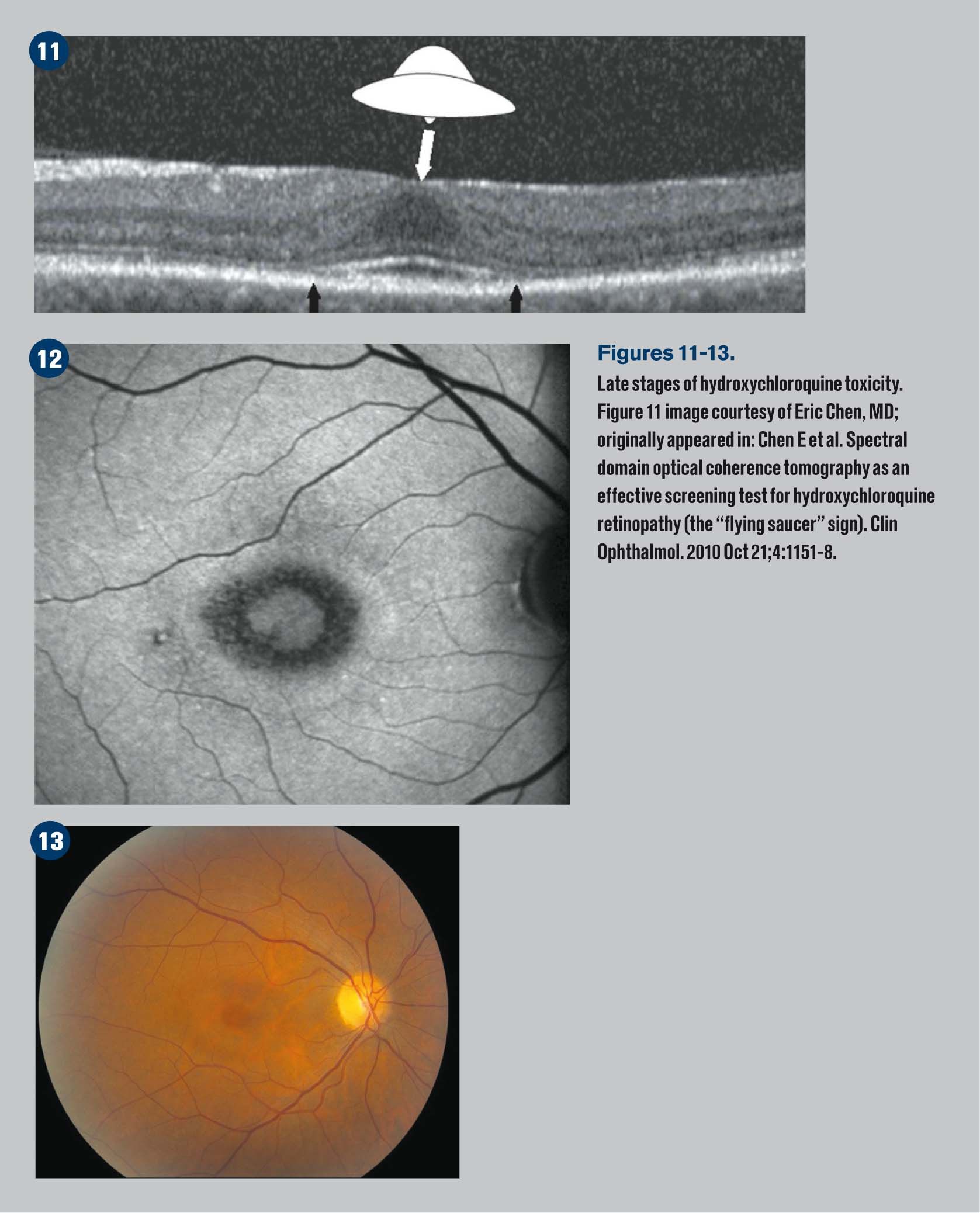 Identifying common macular conditions with OCT