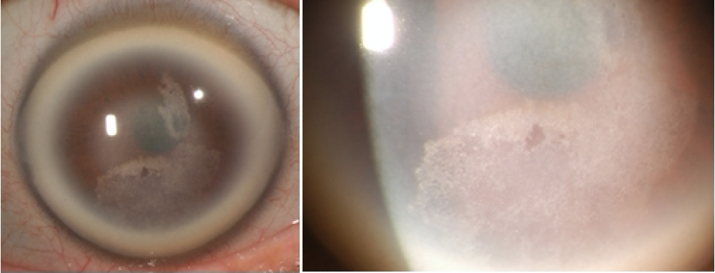 visual-haze-leads-to-diagnosing-unknown-corneal-dystrophy