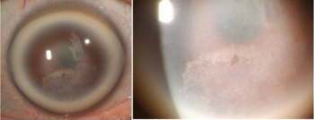 Figure 1. Corneal findings with dense arcus, central stromal haze, and subepith