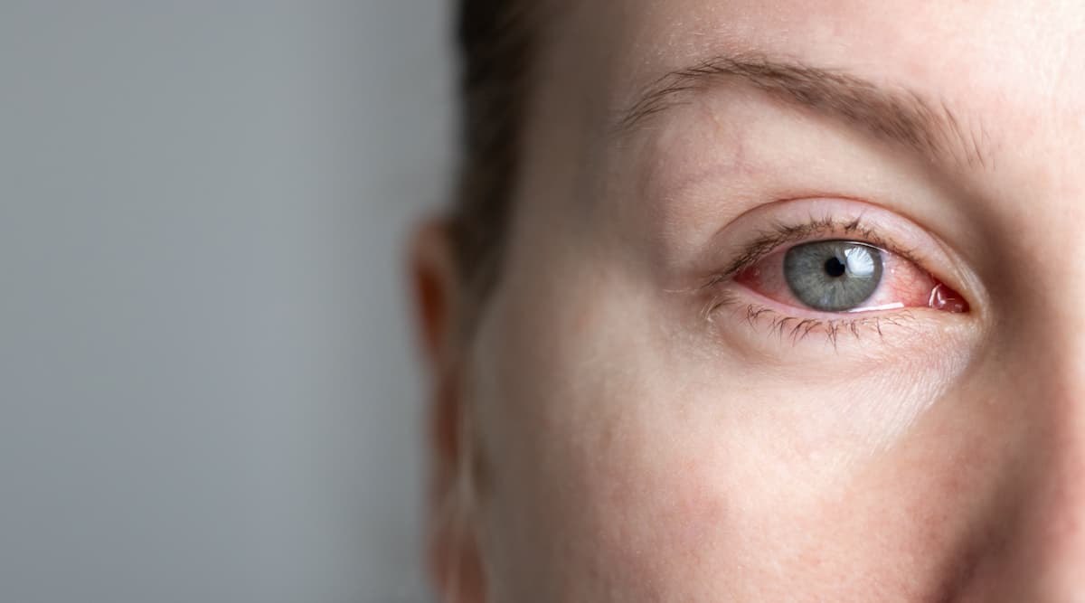 Inflamed eye Image credit: AdobeStock/TatjanaMeininger