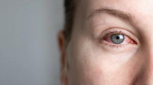 Inflamed eye Image credit: AdobeStock/TatjanaMeininger