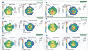 Figure 1. Measuring progress with both axial and tangential topography scans, th