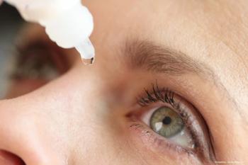 New data for reproxalap for dry eye disease meets primary end point, Aldeyra Therapeutics says. ©megaflopp—stock.adobe.com