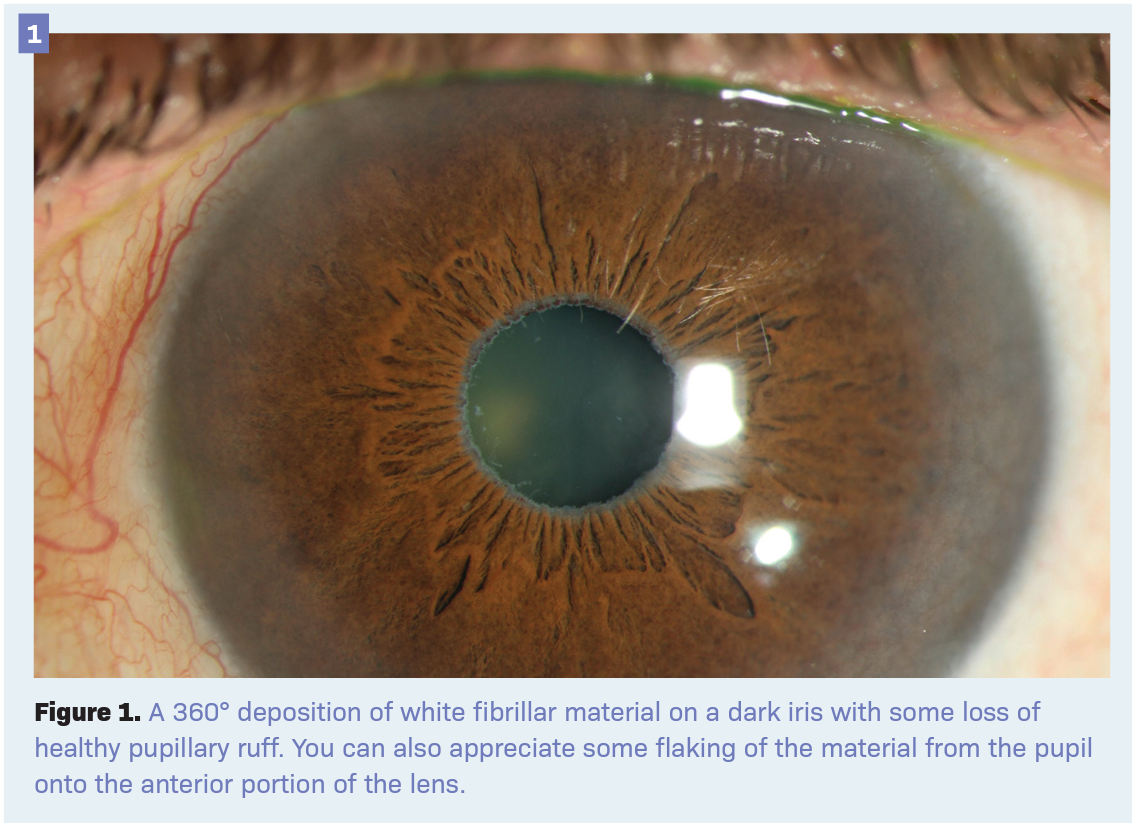 Peripupillary prognosticators of glaucoma | Optometry Times - Clinical News  \u0026 Expert Optometrist Insights, image size:1132x826