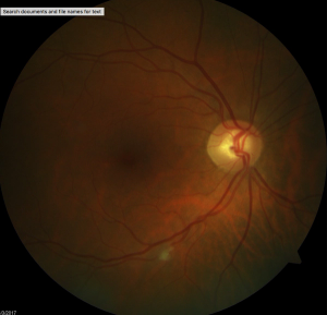 Know the link between cotton wool spot and anemia