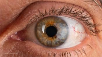 Eye of an elderly man diagnosed with keratoconus and corneal thinning. Concept image for Epion Therapeutics fast track FDA designation, EpiSmart corneal cross-linking. Image credit: ©Fukume – stock.adobe.com