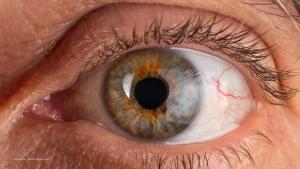 Eye of an elderly man diagnosed with keratoconus and corneal thinning. Concept image for Epion Therapeutics fast track FDA designation, EpiSmart corneal cross-linking. Image credit: ©Fukume – stock.adobe.com