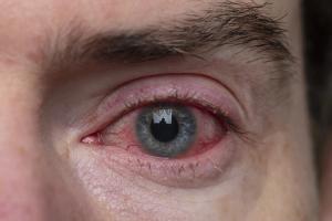 Blepharitis requires patient education