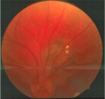 Figure 1. Color fundus photograph at baseline.The distinct borders of the slate-gray lesion are evident and even more distinct at clinical examination. The lesion itself extends just temporal to the retinal venule exiting the optic disc superiorly (broad arrow).