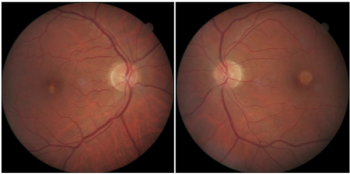 Figure 1. The right and left fundus images of the case. 