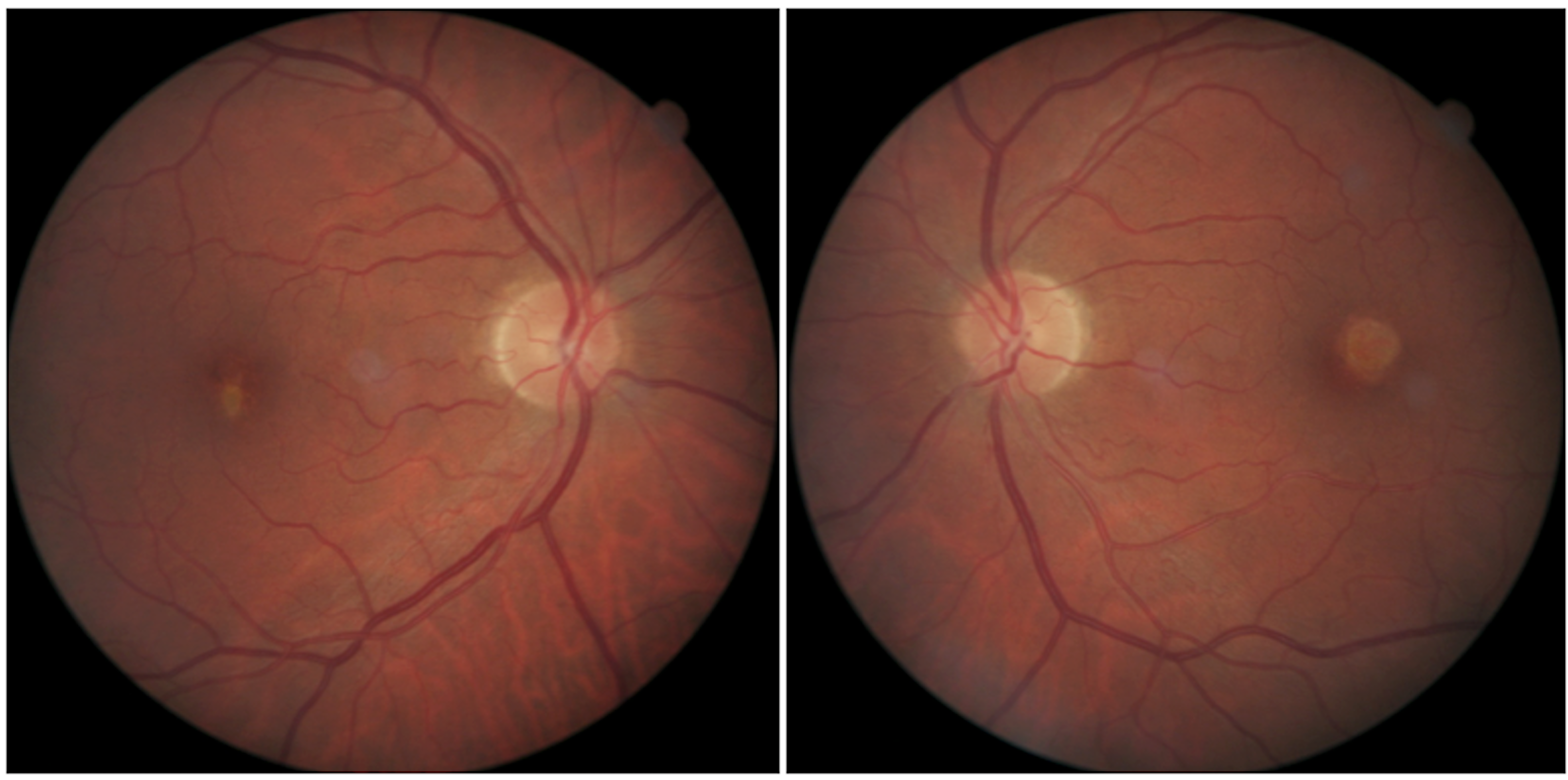 Figure 1. The right and left fundus images of the case. 