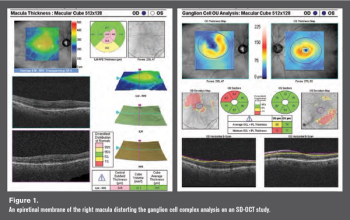 Figure 1 glaucoma