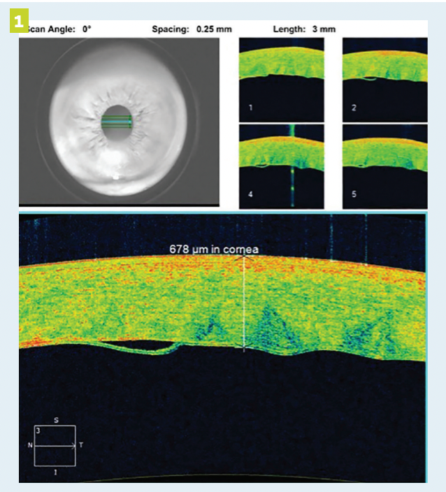 At the 3-week postoperative visit, cornal cross section imaging via optical coherence tomography revealed sufficient reattachment and a persistently edematous cornea. The patient continued a treatment course of topical steroids.