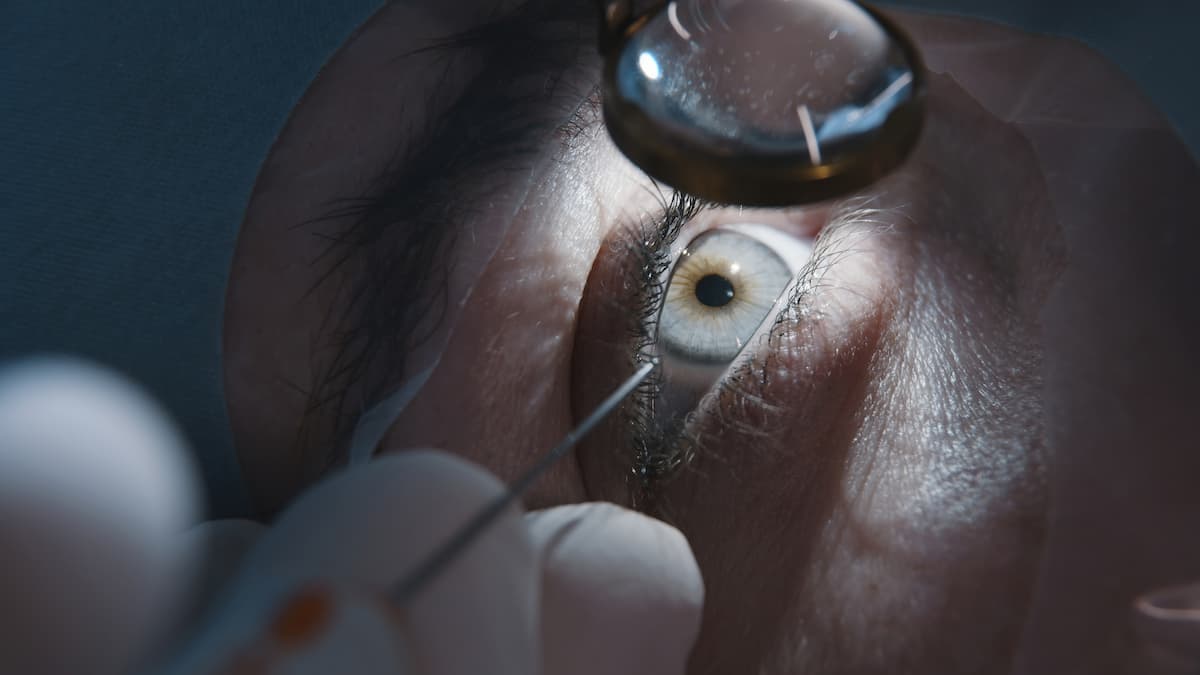 Refractive surgery Image credit: AdobeStock/Vladislav