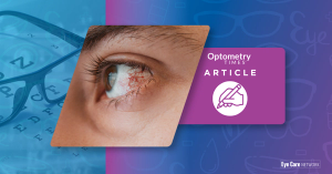 Closeup of keratitis in eye