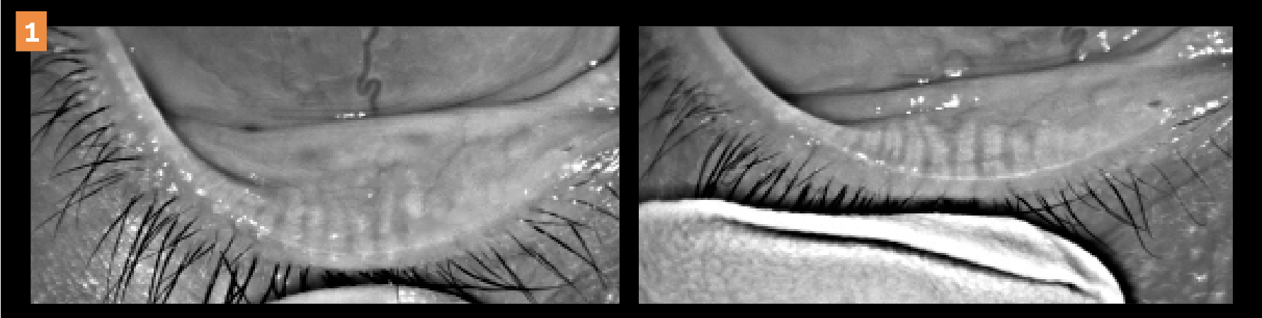 Meibography images show before (left) and after (right) in-office dry eye treatments of a 27-year-old female patient with a recent history of isotretinoin. 