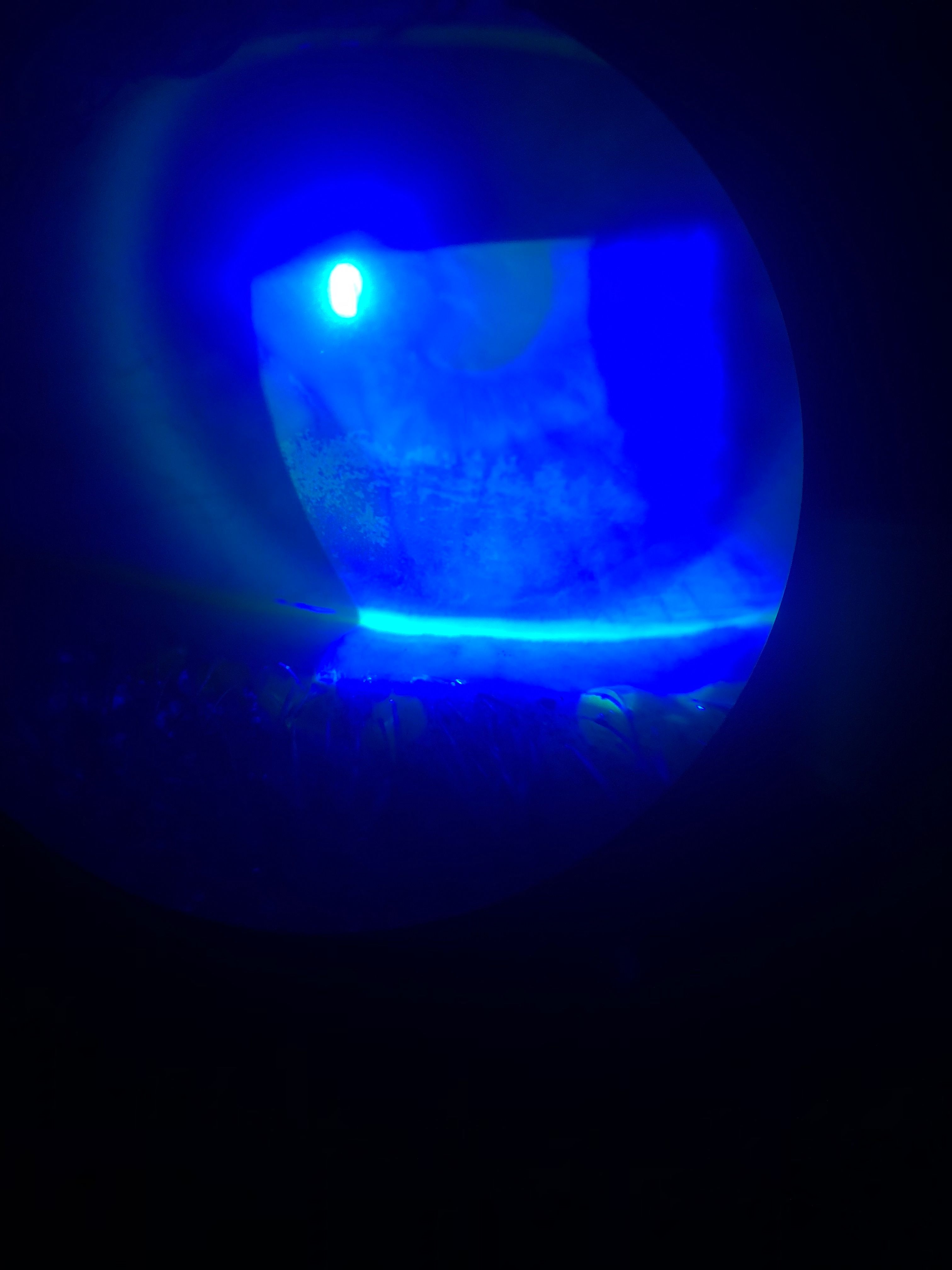 Interpalpebral corneal staining