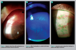 Scleral contact lenses help manage ocular surface disease