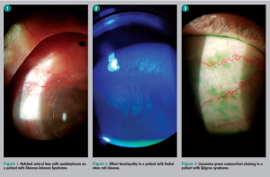 Scleral contact lenses help manage ocular surface disease