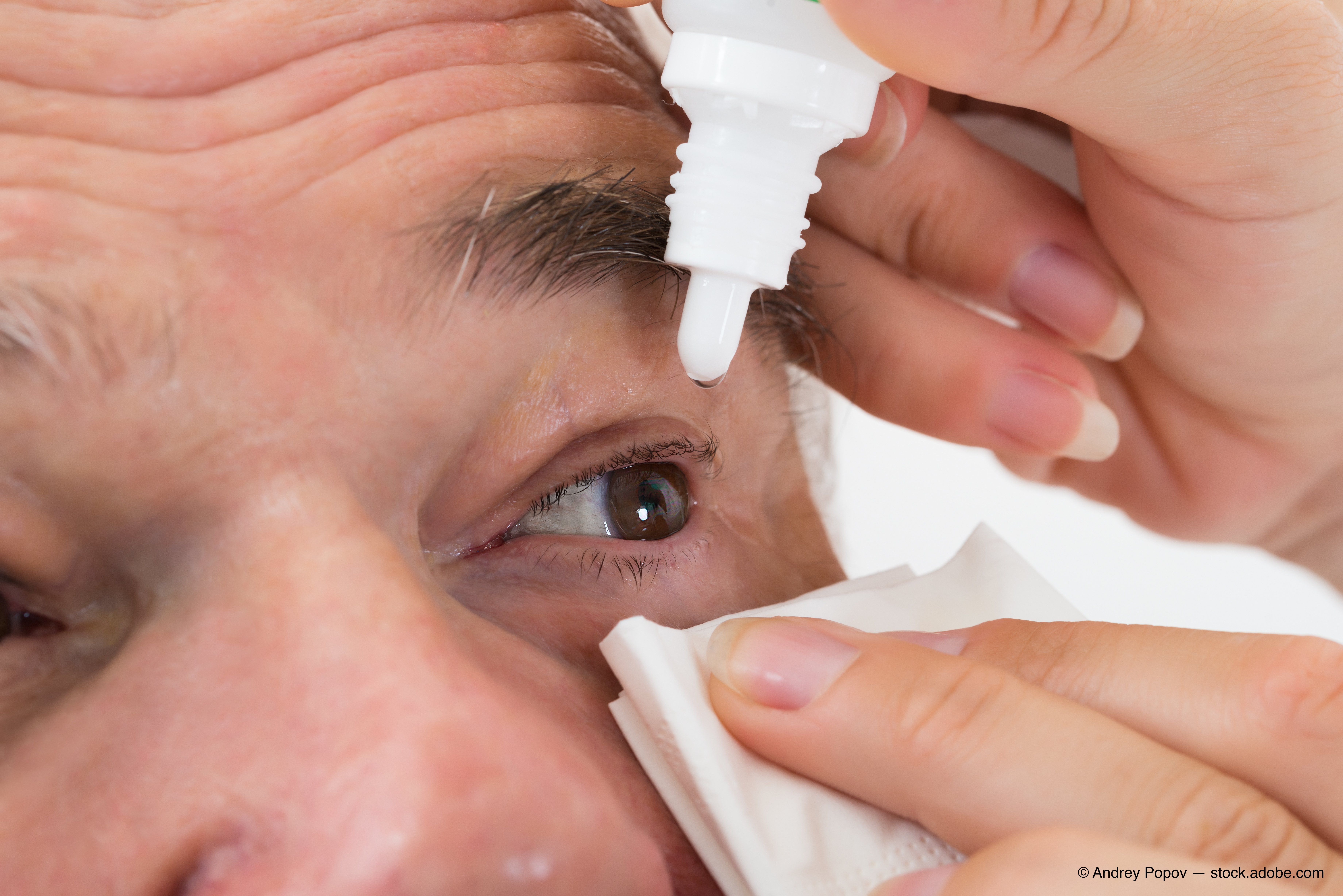 Treat dry eye disease first, address comfort next