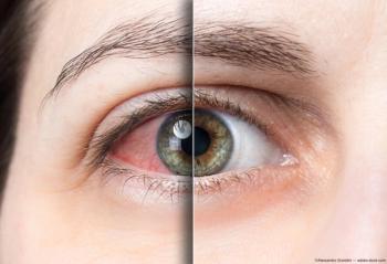 Closeup of dry eye before and after treatment. Image credit: AdobeStock/AlessandroGrandini