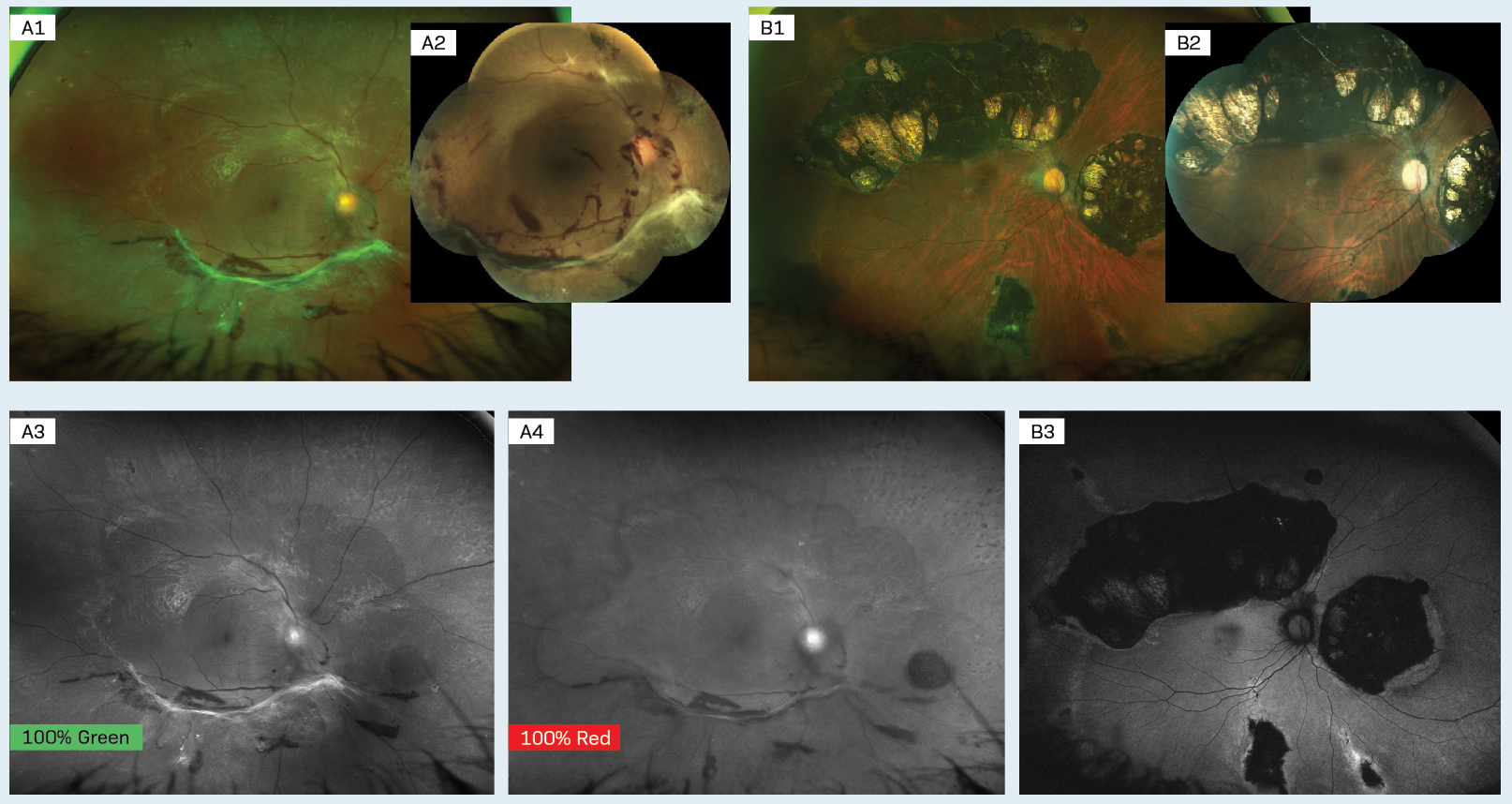Imaging technology helps in scanning for retinal diseases
