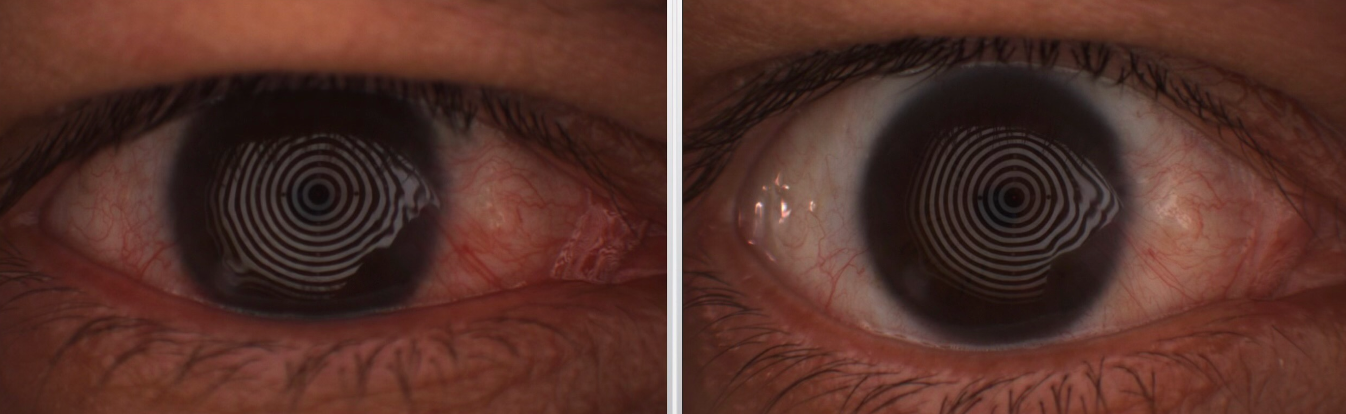 How dry eye awareness social media campaigns benefit both patients and practicesHow dry eye awareness social media campaigns benefit both patients and practices