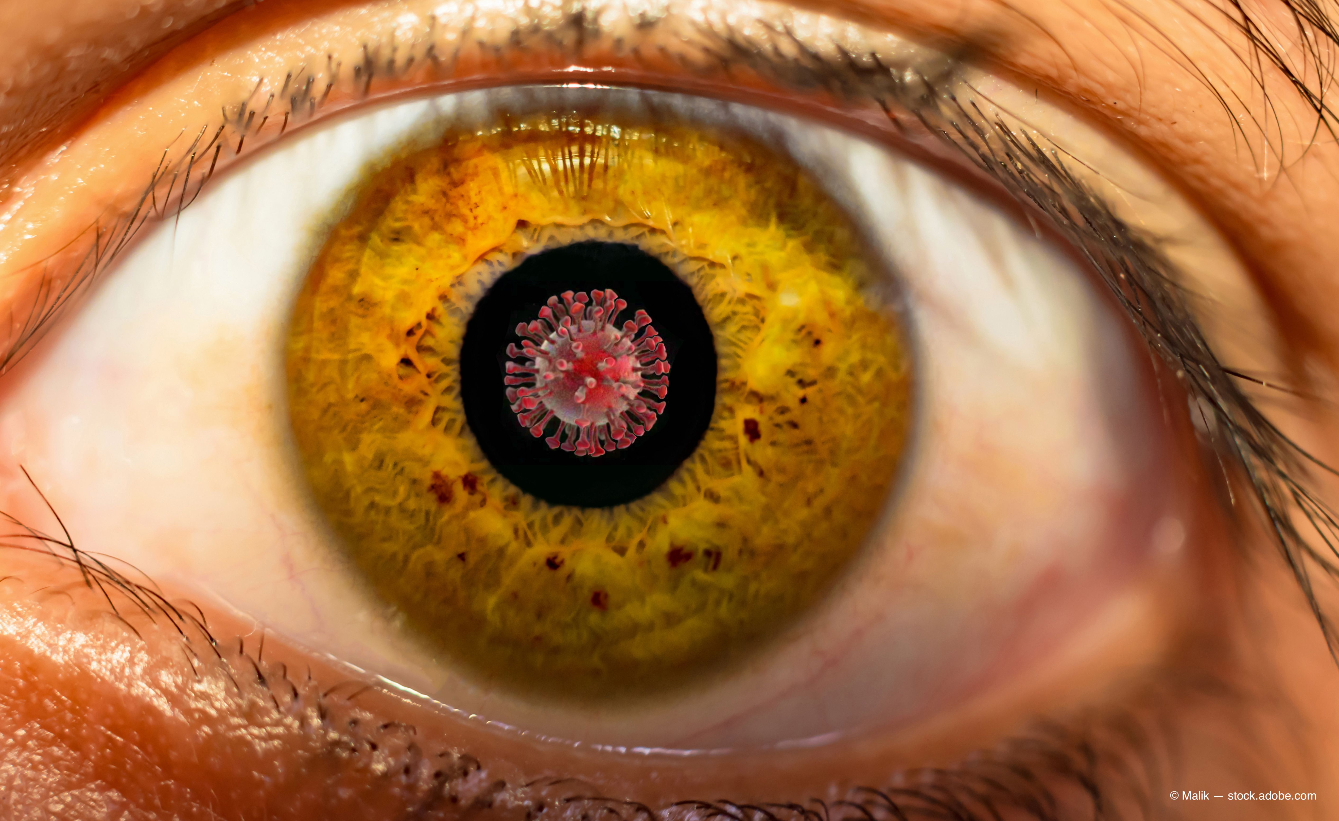  Active COVID-19 can affect the pupillary diameter, according to Turkish investigators Serap Yurttaser Ocak, MD, and colleagues, who reported finding significant differences in the pupillary diameters between when the virus was active and 3 months later