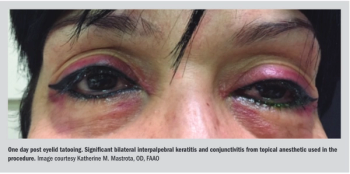 One day post-eyelid tattooing 