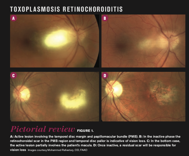 active lesion in retina scan