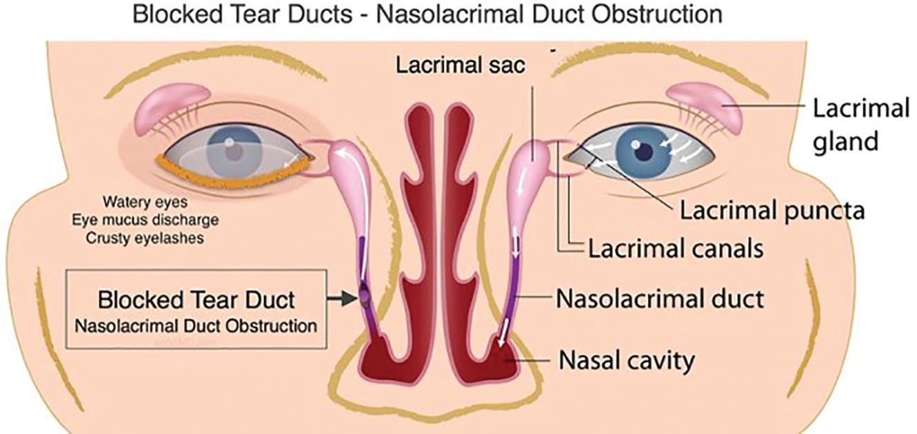 can semaglutide cause sinus problems Sinus congestion can lead to vision changes, dry eye syndrome | Optometry Times