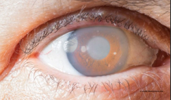 UK guidelines for glaucoma treatment make significant change