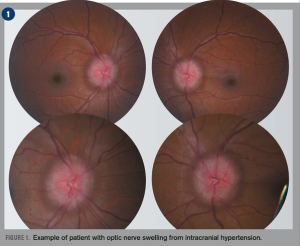  How to diagnose a swollen optic nerve 