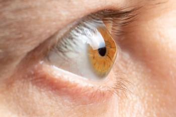 Cornea with keratoconus Image credit: AdobeStock/ZarinaLukash