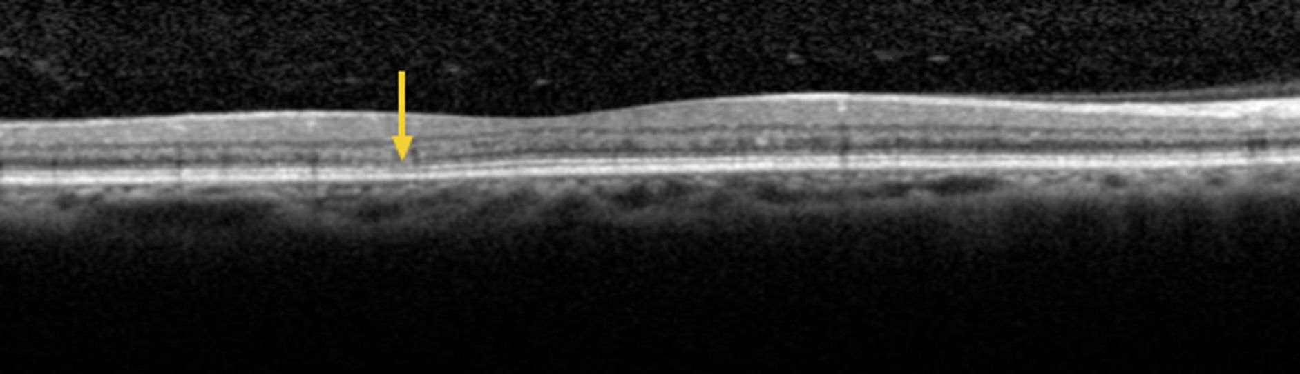 semaglutide and plaquenil New tools emerge for the early detection of hydroxychloroquine maculopathy  | Optometry Times