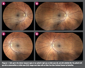 Roth spot in eye