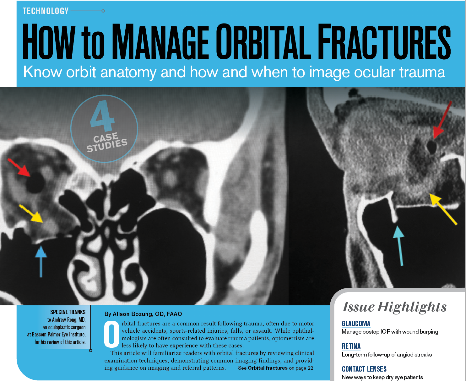 How To Manage Orbital Fractures