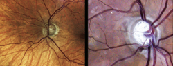 New treatments and surgeries are transforming the glaucoma landscape 