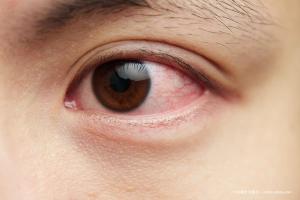 CAM for the treatment of Sjögren syndrome–related ocular surface disease