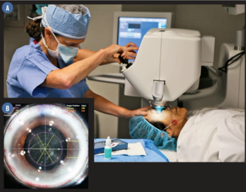 Refractive Surgery