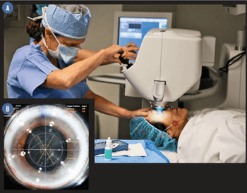 Refractive Surgery