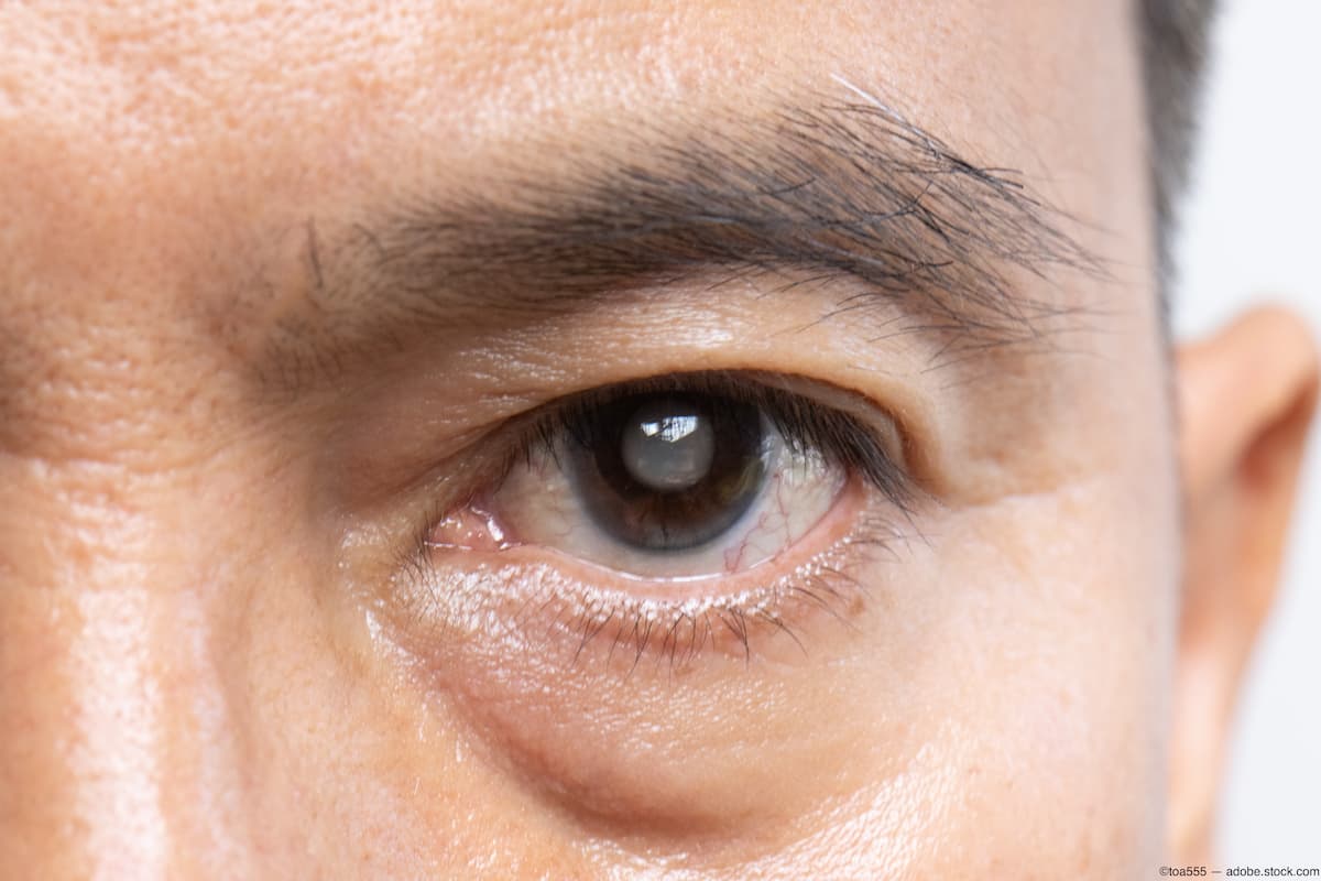 Closeup of older man's cataract Image credit: AdobeStock/toa555