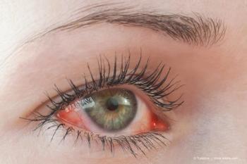 Dry eye Image credit: AdobeStock/Tunatura