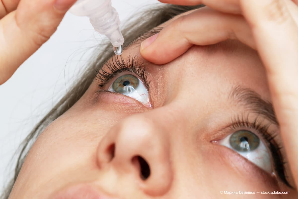 Artificial tears are artificial, with ingredients that aren’t produced by the human body. How can we ensure that patients who need these products get the hydration and protection they need? (Adobe Stock Images/Марина Демешко)