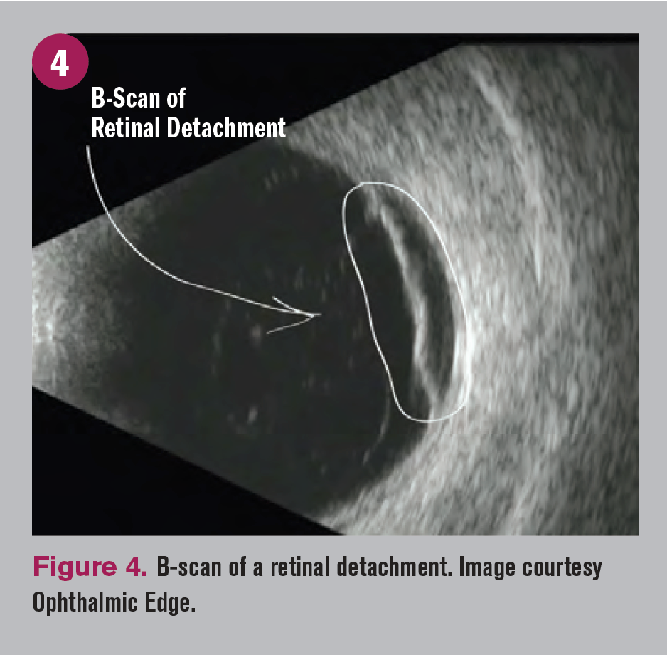 B-scan of retinal detachment