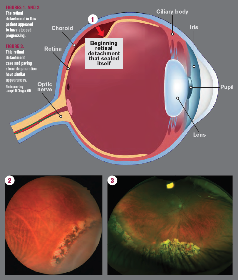 Retinal Detachment Seals Itself