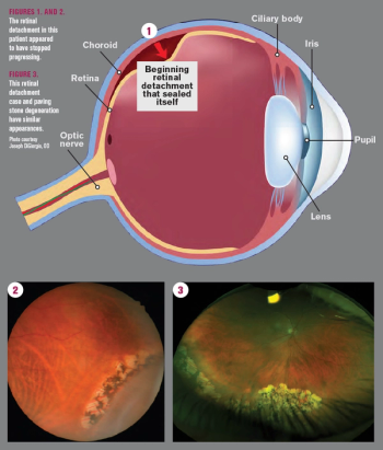 Retinal detachment seals itself