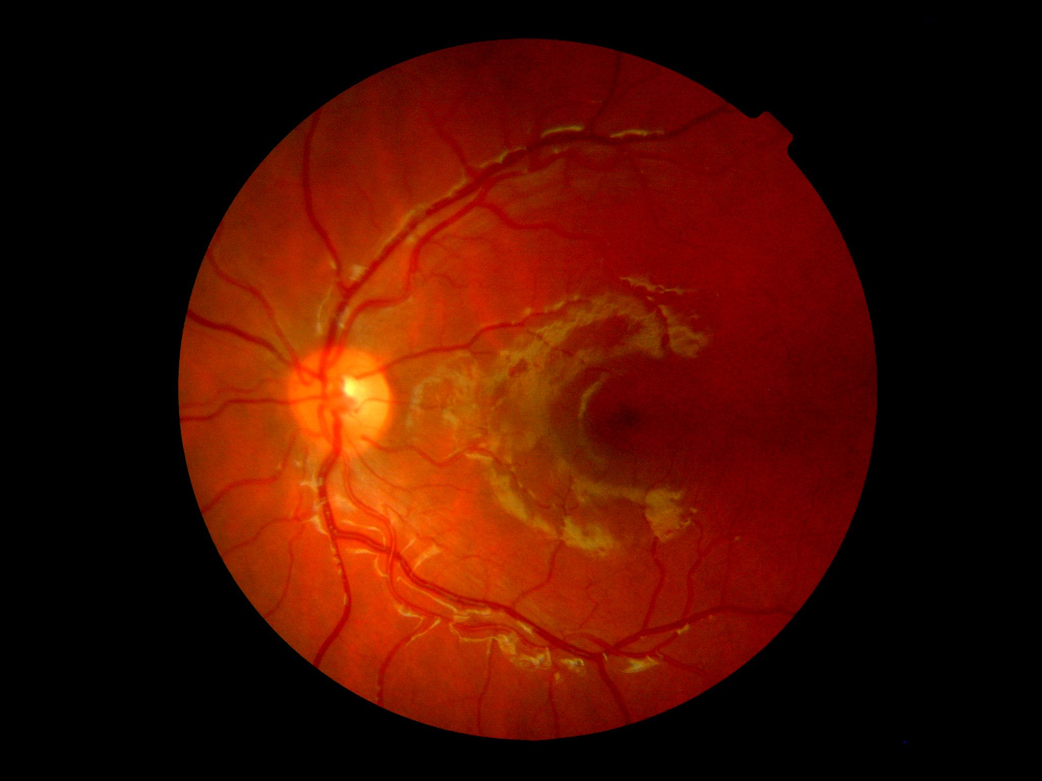 4-year-old patient retinal scan with suspected Coats disease
