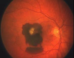 Macular degeneration A to Z